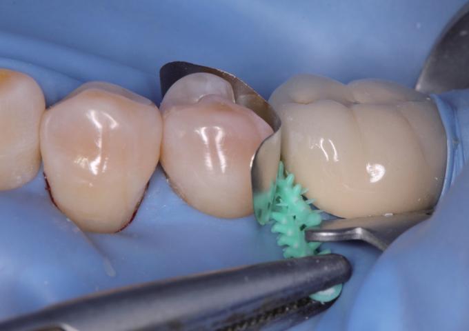 Composite Dental Sectional Matrix System Plastic Adaptive Wedges W3 1.0 3